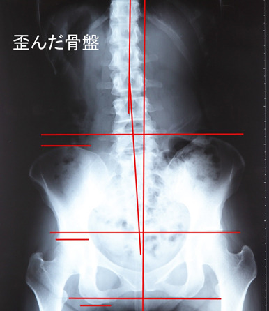 レントゲンで歪みを確認し正確な骨格矯正治療 すがの接骨院