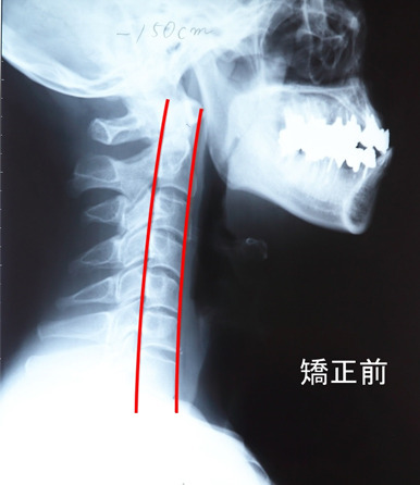 頚椎矯正前