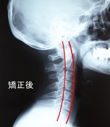 頚椎矯正後