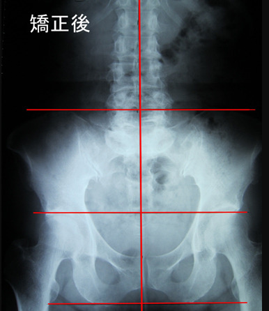 骨盤矯正後