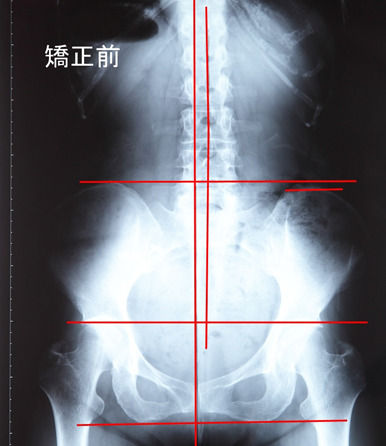 骨盤矯正前